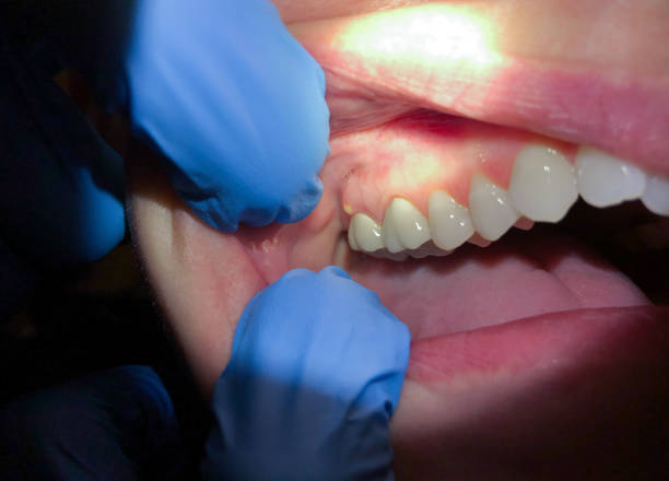 Best Broken or Cracked Tooth Emergency Dentist in Thornville, OH
